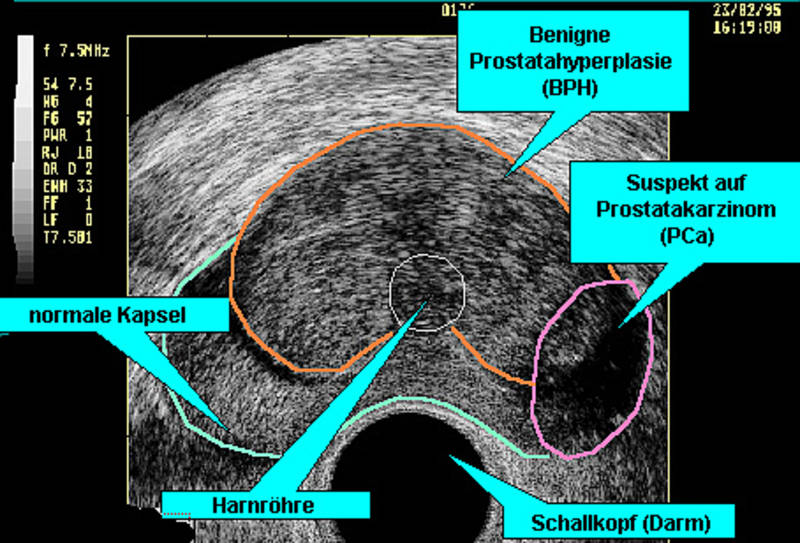 prostata normale größe sonographie)